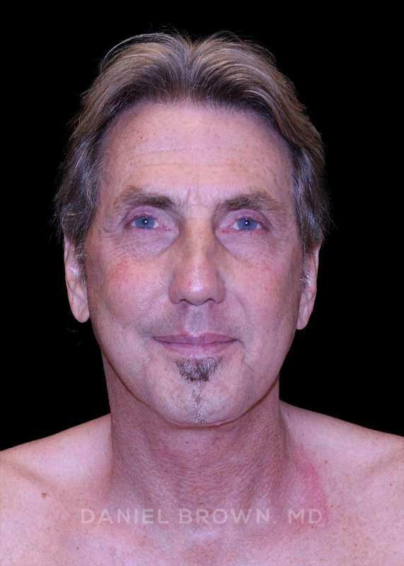 Top Plastic Surgeon San Diego: Dr. Daniel Brown after — San Diego, CA