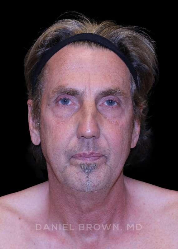 Facelift before at Top Plastic Surgeon San Diego: Dr. Daniel Brown in San Diego, CA