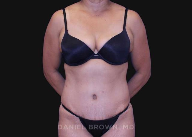 Tummy Tuck after at Top Plastic Surgeon San Diego: Dr. Daniel Brown in San Diego, CA