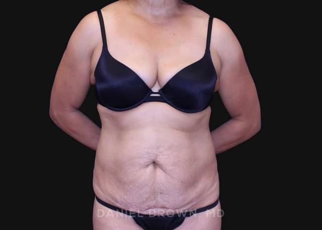 Tummy Tuck before at Top Plastic Surgeon San Diego: Dr. Daniel Brown in San Diego, CA
