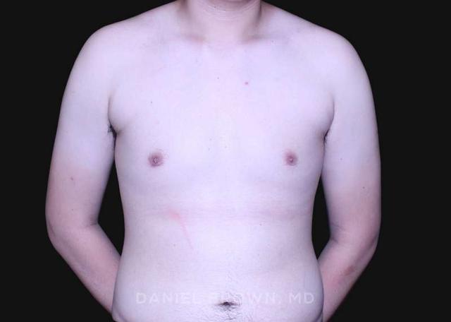 Gynecomastia Surgery after at Top Plastic Surgeon San Diego: Dr. Daniel Brown in San Diego, CA
