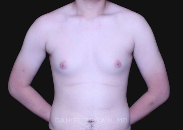 Gynecomastia Surgery before at Top Plastic Surgeon San Diego: Dr. Daniel Brown in San Diego, CA