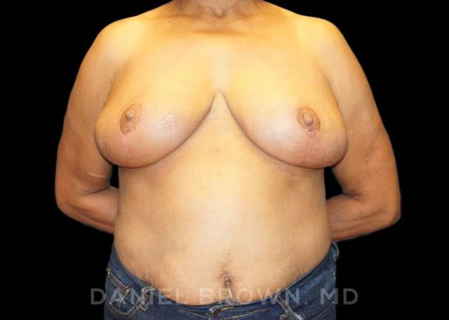 Breast Reduction after at Top Plastic Surgeon San Diego: Dr. Daniel Brown in San Diego, CA