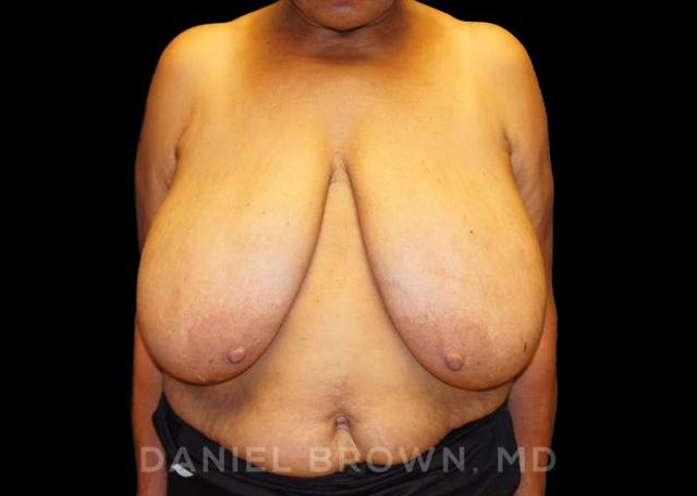 Breast Reduction before at Top Plastic Surgeon San Diego: Dr. Daniel Brown in San Diego, CA