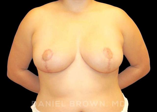 Breast Reduction after at Top Plastic Surgeon San Diego: Dr. Daniel Brown in San Diego, CA