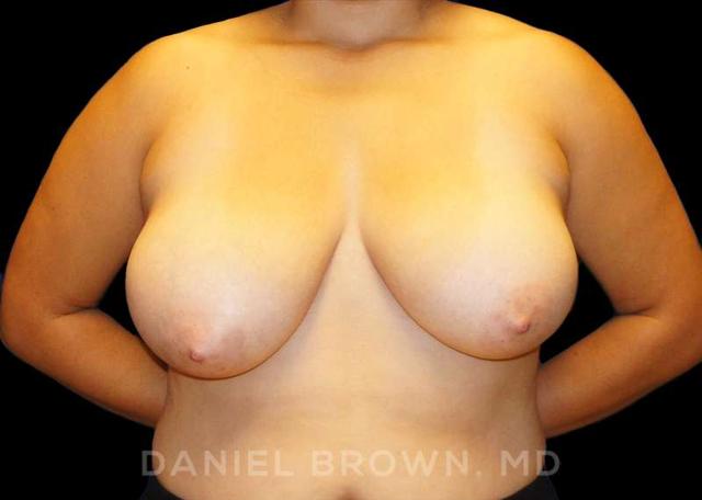 Breast Reduction before at Top Plastic Surgeon San Diego: Dr. Daniel Brown in San Diego, CA