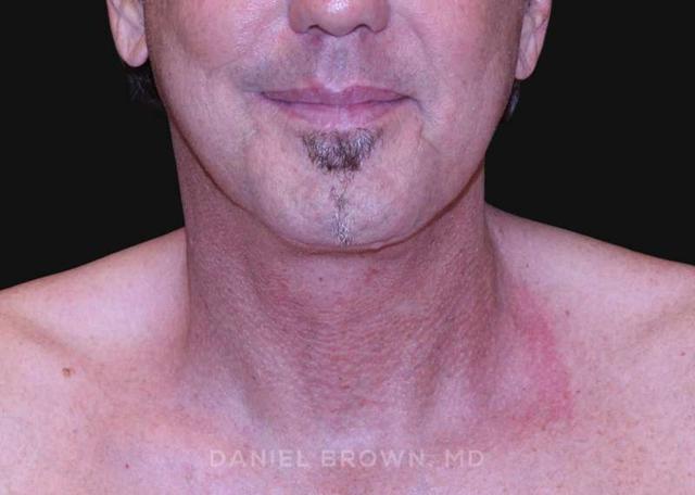 Neck Lift after at Top Plastic Surgeon San Diego: Dr. Daniel Brown in San Diego, CA