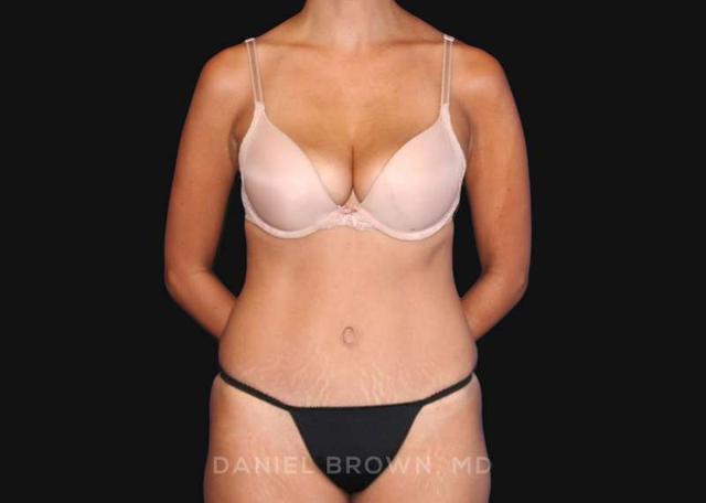 Tummy Tuck after at Top Plastic Surgeon San Diego: Dr. Daniel Brown in San Diego, CA