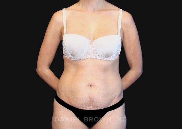 Tummy Tuck before at Top Plastic Surgeon San Diego: Dr. Daniel Brown in San Diego, CA