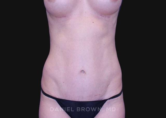 Mommy Makeover after at Top Plastic Surgeon San Diego: Dr. Daniel Brown in San Diego, CA