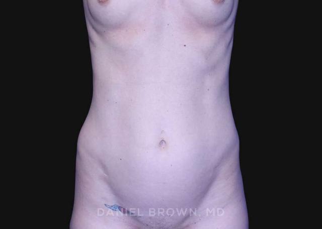 Mommy Makeover before at Top Plastic Surgeon San Diego: Dr. Daniel Brown in San Diego, CA