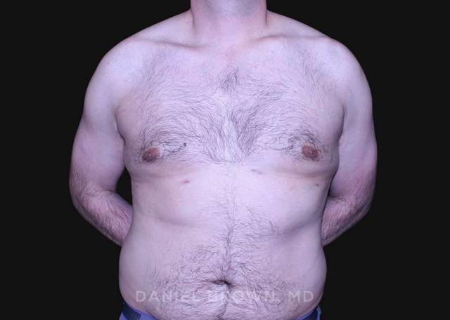Gynecomastia Surgery after at Top Plastic Surgeon San Diego: Dr. Daniel Brown in San Diego, CA