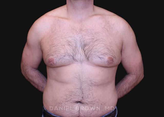 Gynecomastia Surgery before at Top Plastic Surgeon San Diego: Dr. Daniel Brown in San Diego, CA