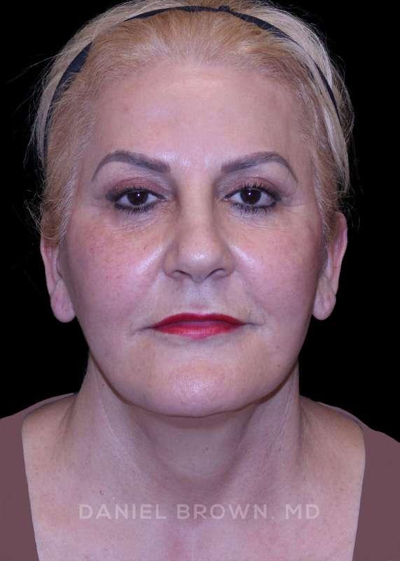 Top Plastic Surgeon San Diego: Dr. Daniel Brown facelift after — San Diego, CA