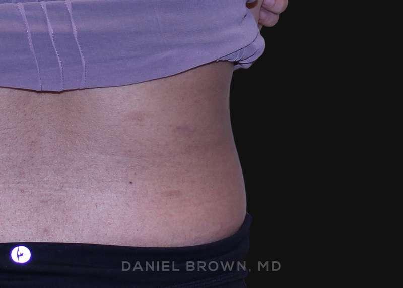 Top Plastic Surgeon San Diego: Dr. Daniel Brown after — San Diego, CA