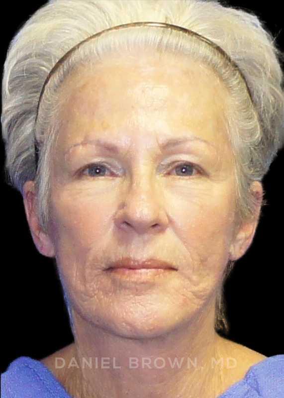 Top Plastic Surgeon San Diego: Dr. Daniel Brown facelift after — San Diego, CA