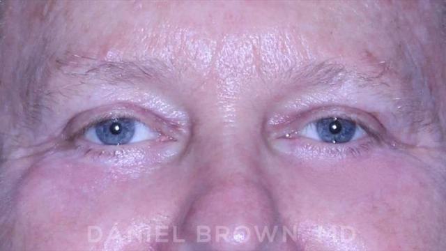Blepharoplasty after at Top Plastic Surgeon San Diego: Dr. Daniel Brown in San Diego, CA