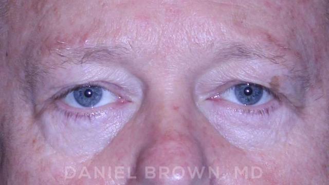 Blepharoplasty before at Top Plastic Surgeon San Diego: Dr. Daniel Brown in San Diego, CA