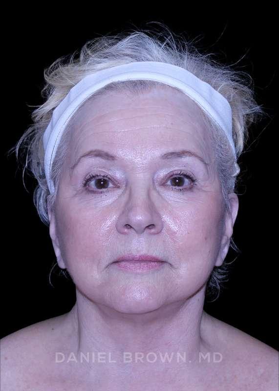Top Plastic Surgeon San Diego: Dr. Daniel Brown facelift after — San Diego, CA