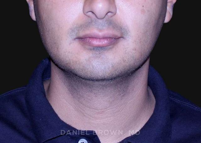 Neck Liposuction after at Top Plastic Surgeon San Diego: Dr. Daniel Brown in San Diego, CA