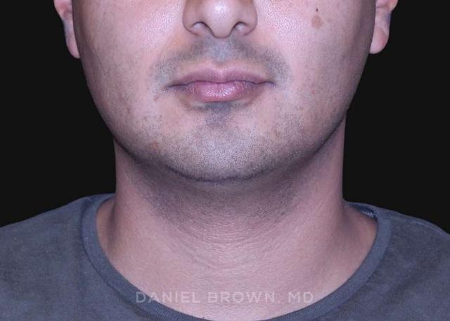Neck Liposuction before at Top Plastic Surgeon San Diego: Dr. Daniel Brown in San Diego, CA