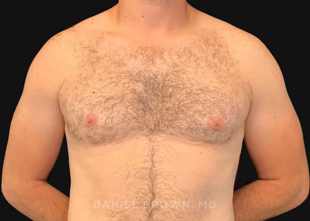 Gynecomastia Surgery after at Top Plastic Surgeon San Diego: Dr. Daniel Brown in San Diego, CA