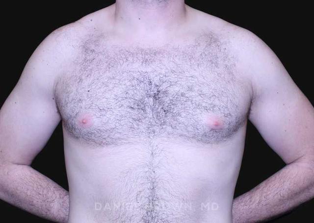 Gynecomastia Surgery before at Top Plastic Surgeon San Diego: Dr. Daniel Brown in San Diego, CA