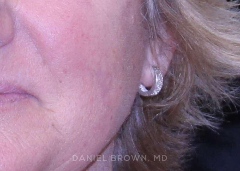 Top Plastic Surgeon San Diego: Dr. Daniel Brown after — San Diego, CA