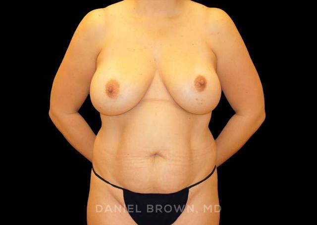 Mommy Makeover before at Top Plastic Surgeon San Diego: Dr. Daniel Brown in San Diego, CA