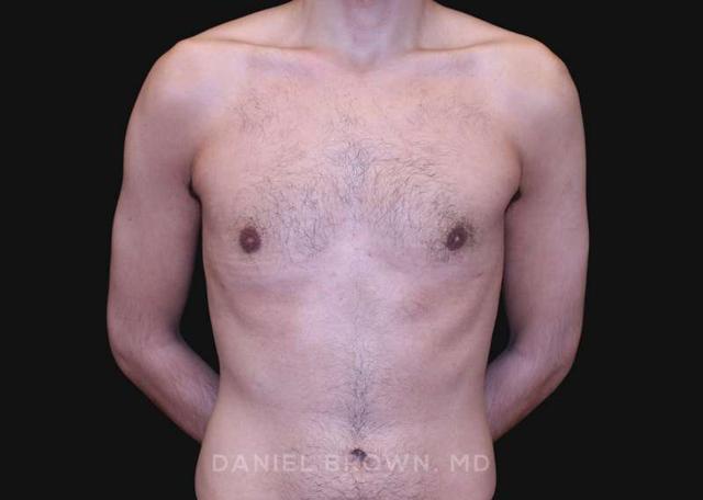 Gynecomastia Surgery after at Top Plastic Surgeon San Diego: Dr. Daniel Brown in San Diego, CA