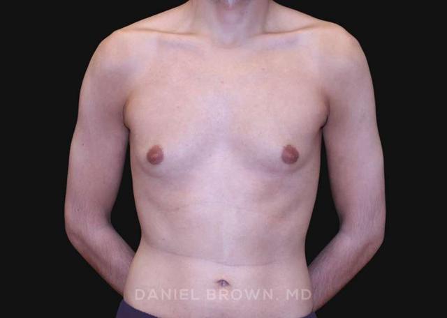 Gynecomastia Surgery before at Top Plastic Surgeon San Diego: Dr. Daniel Brown in San Diego, CA