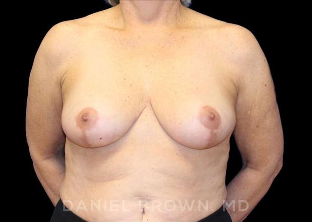 Breast Lift after at Top Plastic Surgeon San Diego: Dr. Daniel Brown in San Diego, CA