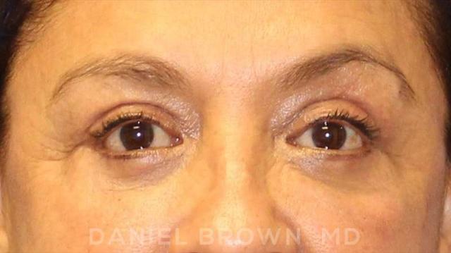 Blepharoplasty after at Top Plastic Surgeon San Diego: Dr. Daniel Brown in San Diego, CA