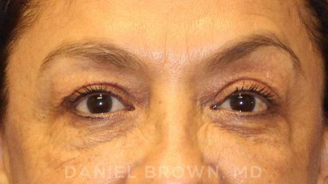 Blepharoplasty before at Top Plastic Surgeon San Diego: Dr. Daniel Brown in San Diego, CA