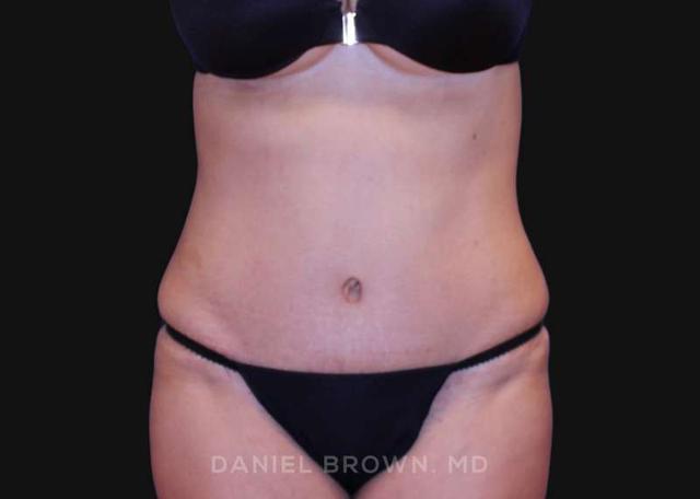 Tummy Tuck after at Top Plastic Surgeon San Diego: Dr. Daniel Brown in San Diego, CA