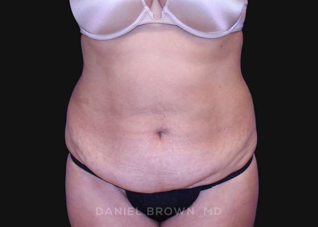 Tummy Tuck before at Top Plastic Surgeon San Diego: Dr. Daniel Brown in San Diego, CA