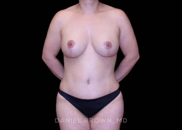 Mommy Makeover after at Top Plastic Surgeon San Diego: Dr. Daniel Brown in San Diego, CA