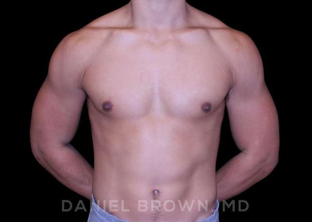 Gynecomastia Surgery after at Top Plastic Surgeon San Diego: Dr. Daniel Brown in San Diego, CA