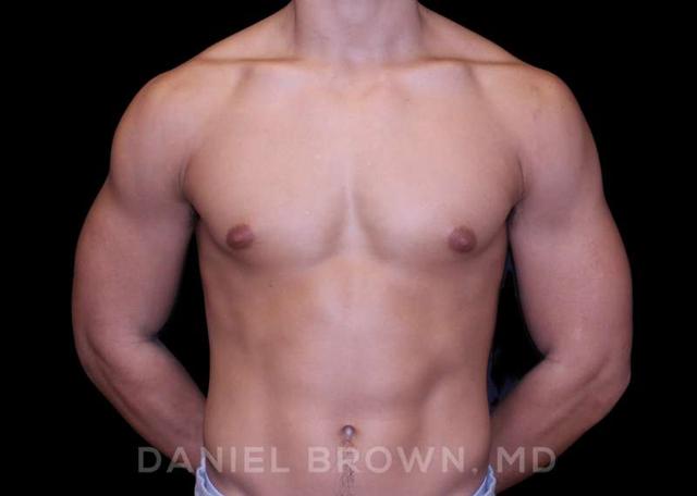 Gynecomastia Surgery before at Top Plastic Surgeon San Diego: Dr. Daniel Brown in San Diego, CA