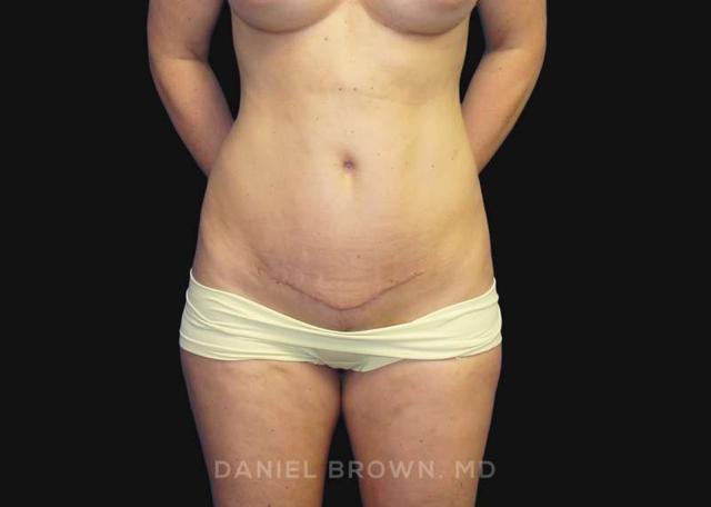 Tummy Tuck after at Top Plastic Surgeon San Diego: Dr. Daniel Brown in San Diego, CA