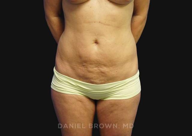 Tummy Tuck before at Top Plastic Surgeon San Diego: Dr. Daniel Brown in San Diego, CA