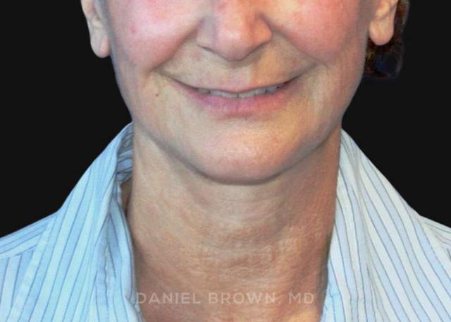 Neck Lift after at Top Plastic Surgeon San Diego: Dr. Daniel Brown in San Diego, CA
