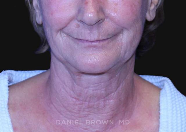 Neck Lift before at Top Plastic Surgeon San Diego: Dr. Daniel Brown in San Diego, CA
