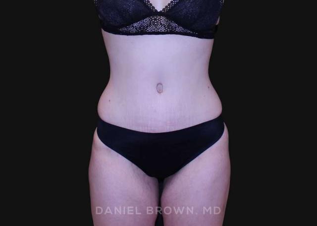 Tummy Tuck after at Top Plastic Surgeon San Diego: Dr. Daniel Brown in San Diego, CA