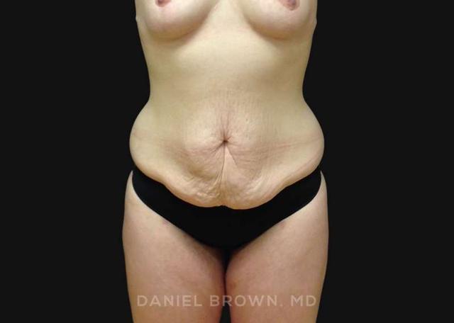 Tummy Tuck before at Top Plastic Surgeon San Diego: Dr. Daniel Brown in San Diego, CA