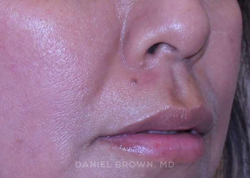 Top Plastic Surgeon San Diego: Dr. Daniel Brown after — San Diego, CA