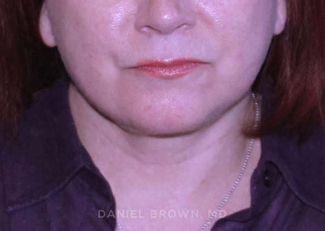 Neck Lift after at Top Plastic Surgeon San Diego: Dr. Daniel Brown in San Diego, CA