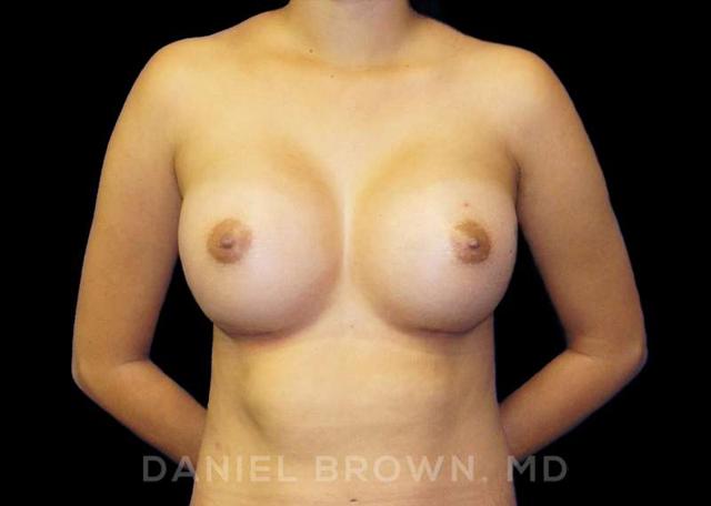 Breast Augmentation after at Top Plastic Surgeon San Diego: Dr. Daniel Brown in San Diego, CA