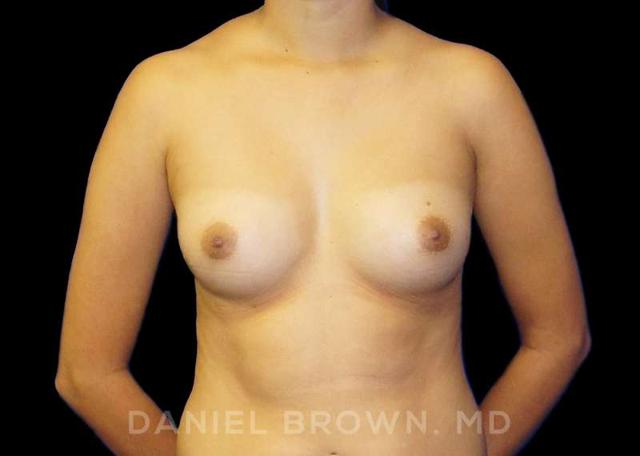Breast Augmentation before at Top Plastic Surgeon San Diego: Dr. Daniel Brown in San Diego, CA