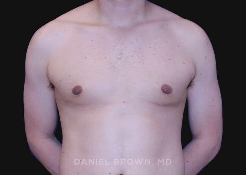 Top Plastic Surgeon San Diego: Dr. Daniel Brown breast reduction after — San Diego, CA